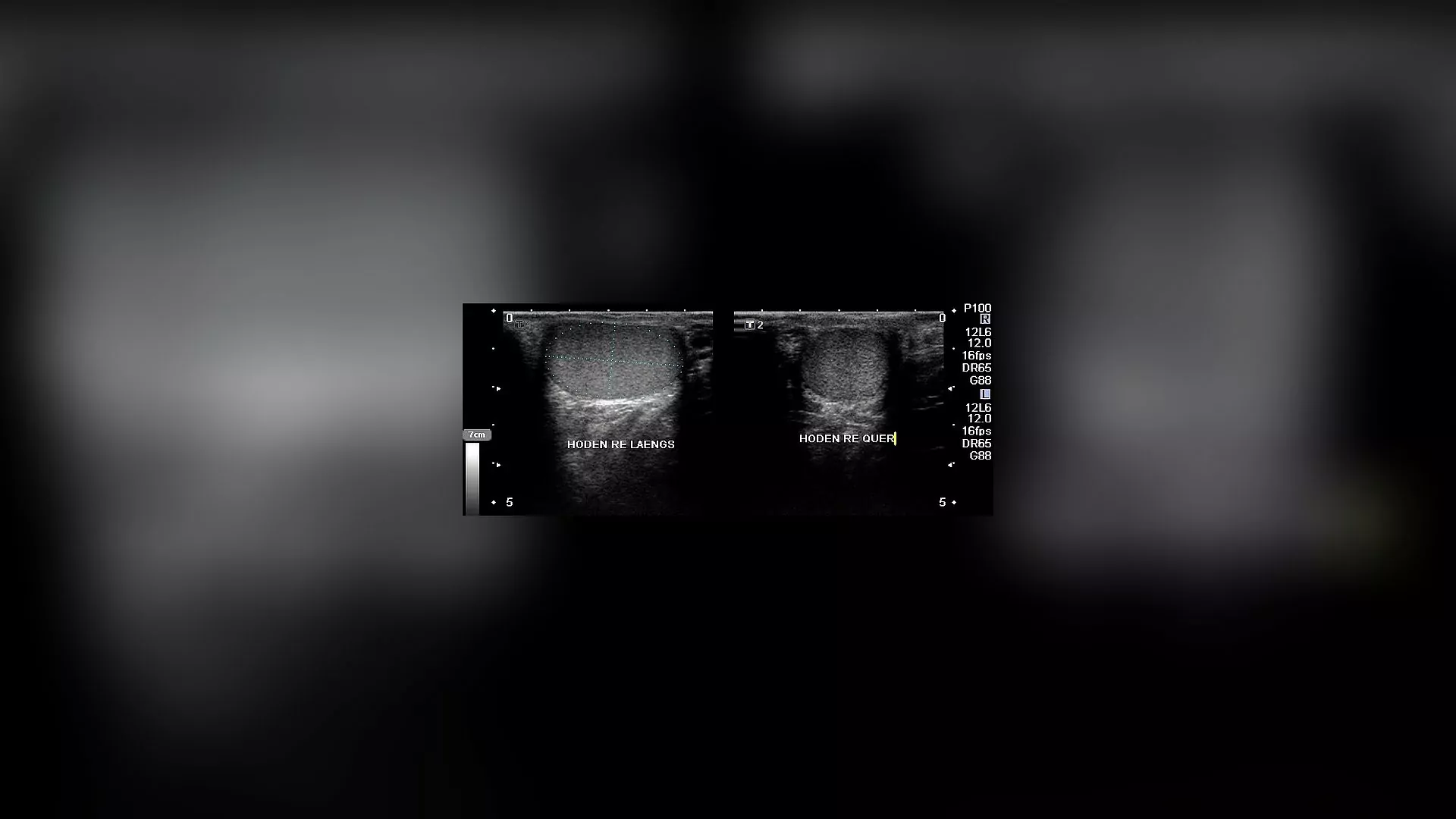 Der Ultraschall wird zur Blasenuntersuchung, Prostatauntersuchung und Penisuntersuchung verwendet.